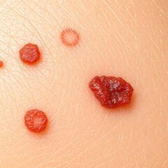 Blizny po wrastających włoskach – przyczyny, zapobieganie i leczenie